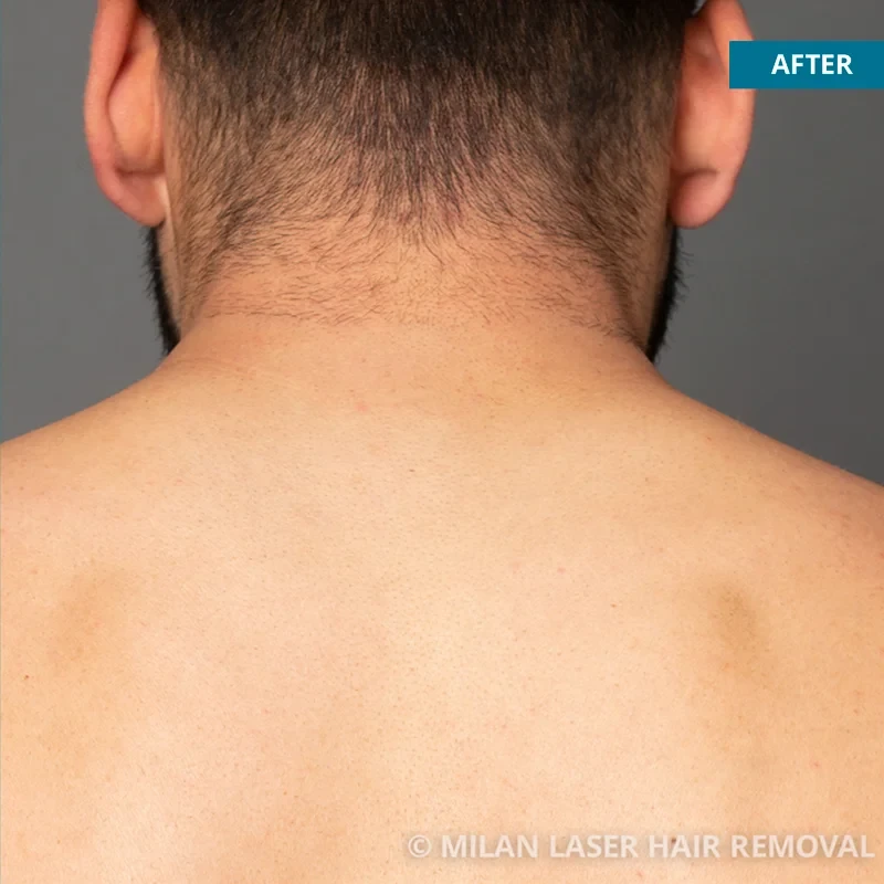 After photo of a men after getting our men laser hair removal treatment