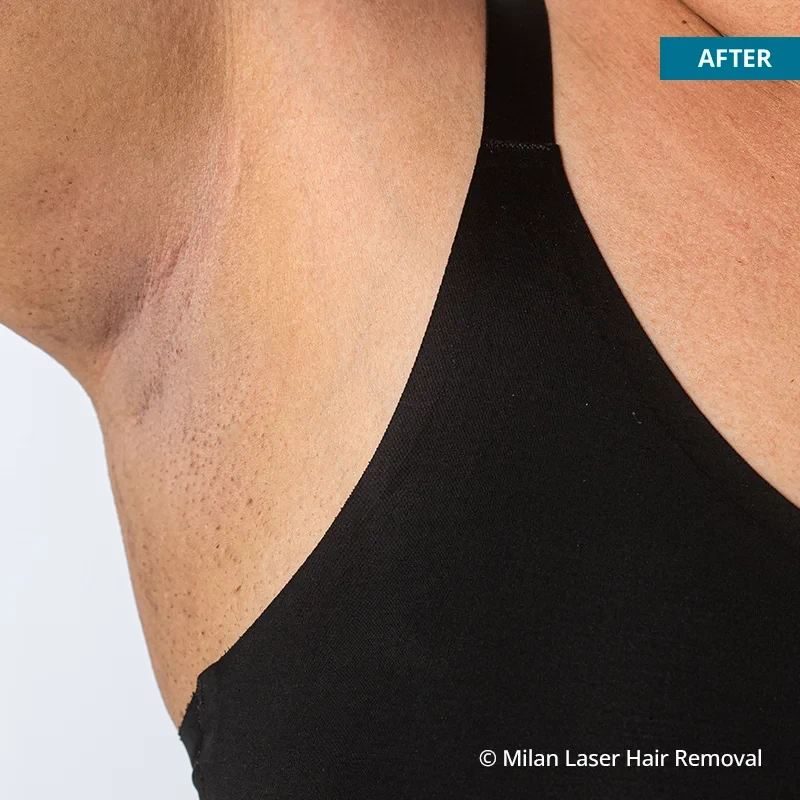 After photo of a underarm after getting our underarm laser hair removal treatment