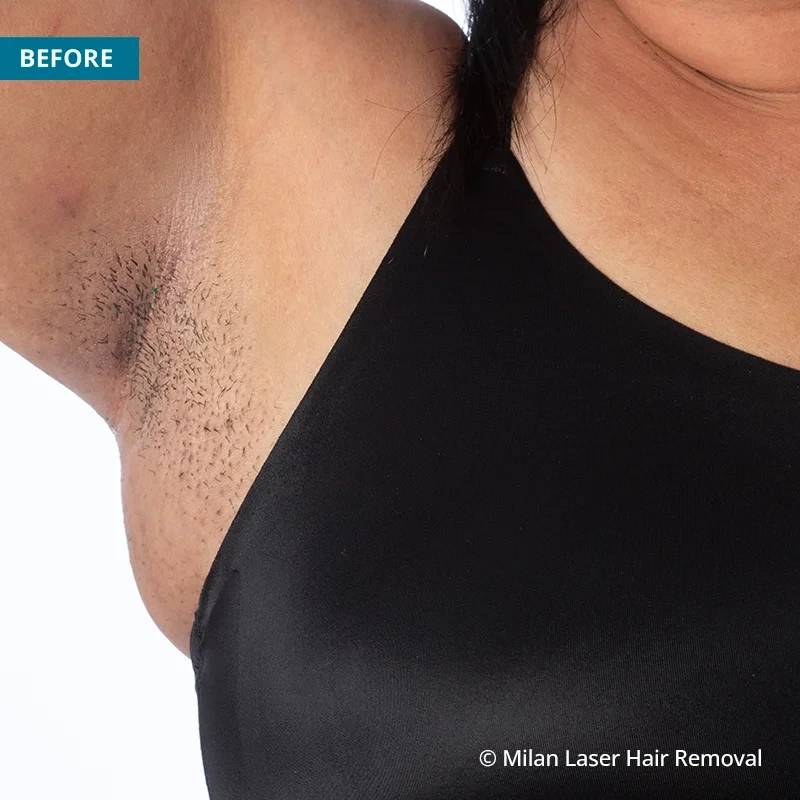 Before photo of a underarm prior to getting our underarm laser hair removal treatment