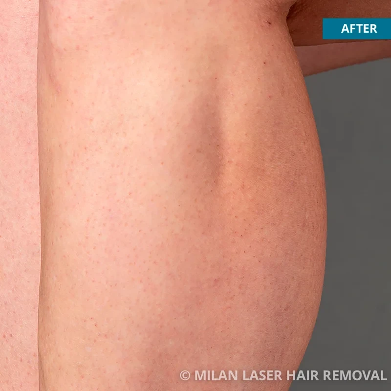 After photo of a legs after getting our legs laser hair removal treatment