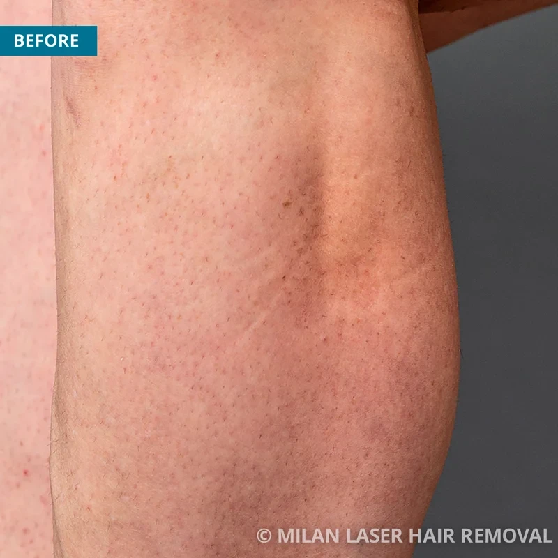 Before photo of a legs prior to getting our legs laser hair removal treatment