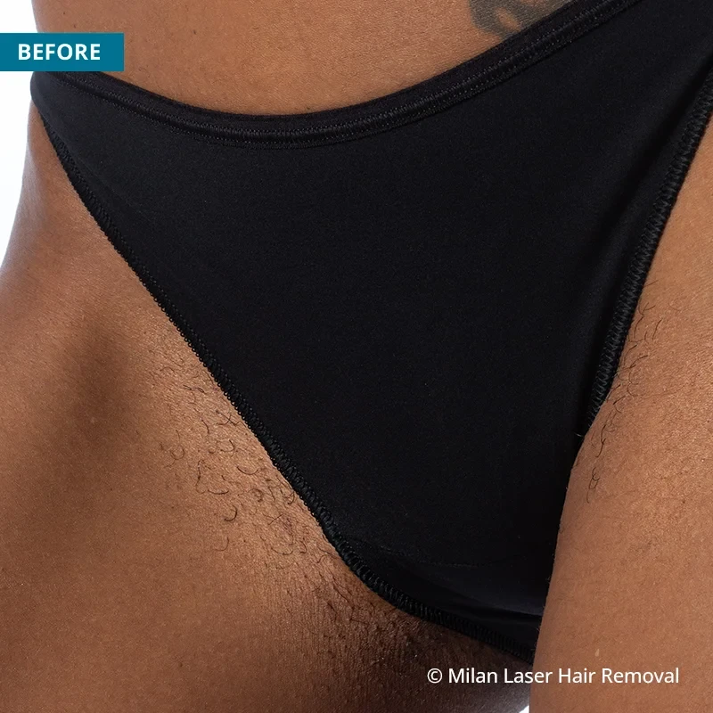 Before photo of a bikini prior to getting our bikini laser hair removal treatment