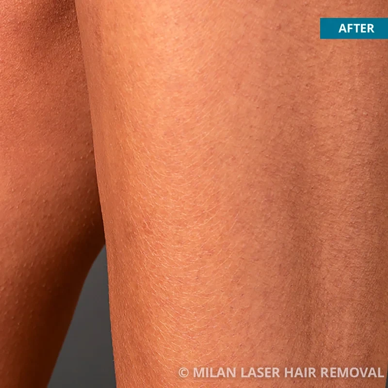 After photo of a legs after getting our legs laser hair removal treatment