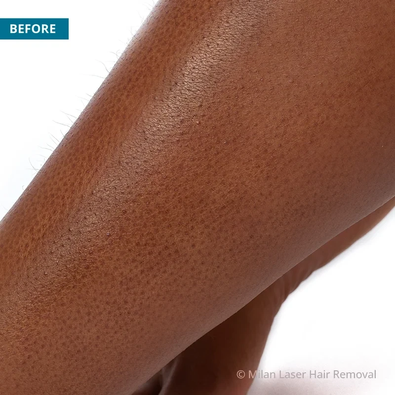 Before photo of a legs prior to getting our legs laser hair removal treatment