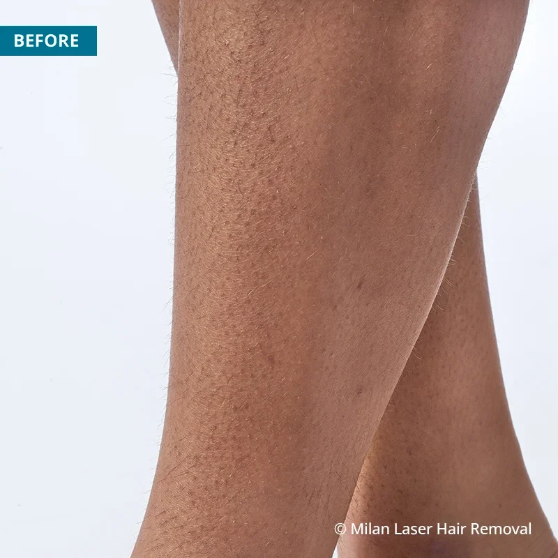 Before photo of a legs prior to getting our legs laser hair removal treatment