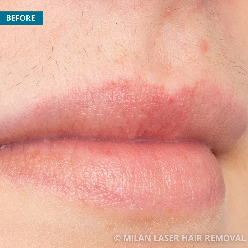 Before photo of a lip prior to getting our lip laser hair removal treatment