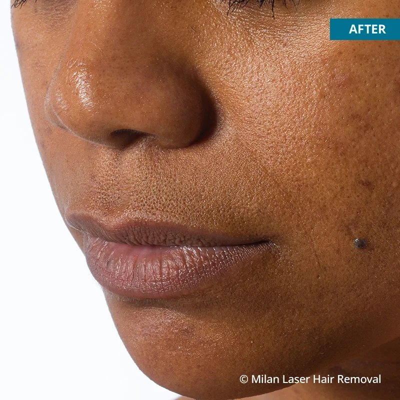 After photo of a lip after getting our lip laser hair removal treatment