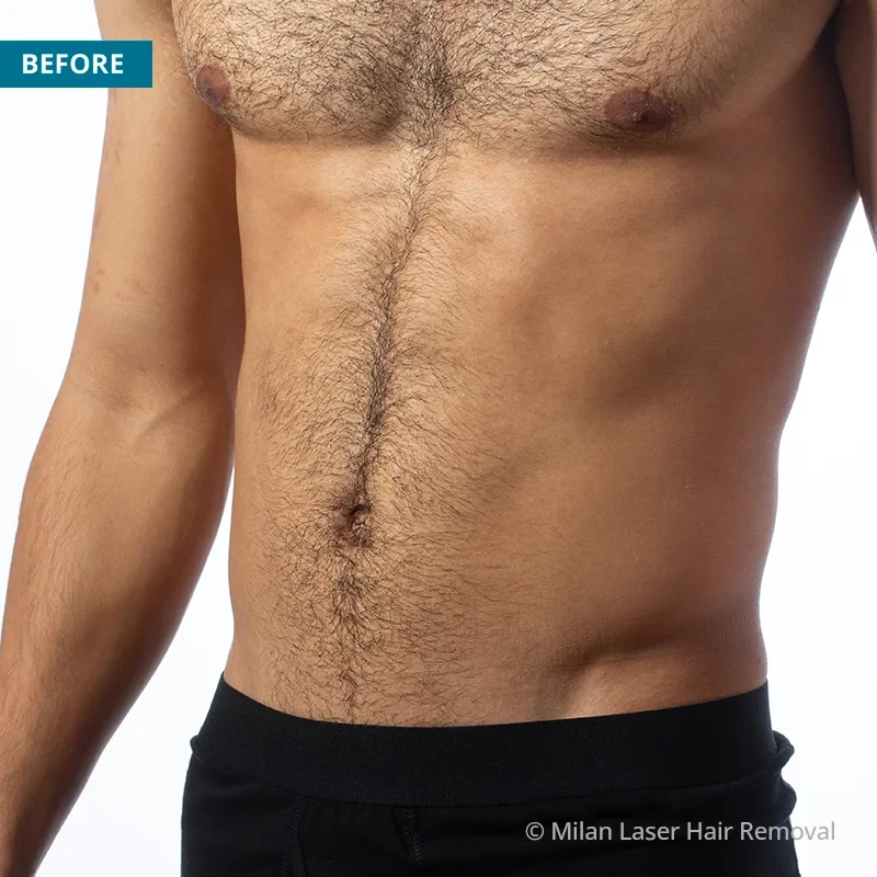 Before photo of a men prior to getting our men laser hair removal treatment