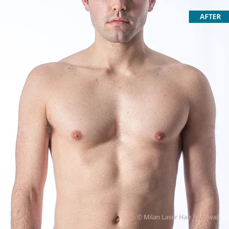 After photo of a men after getting our men laser hair removal treatment