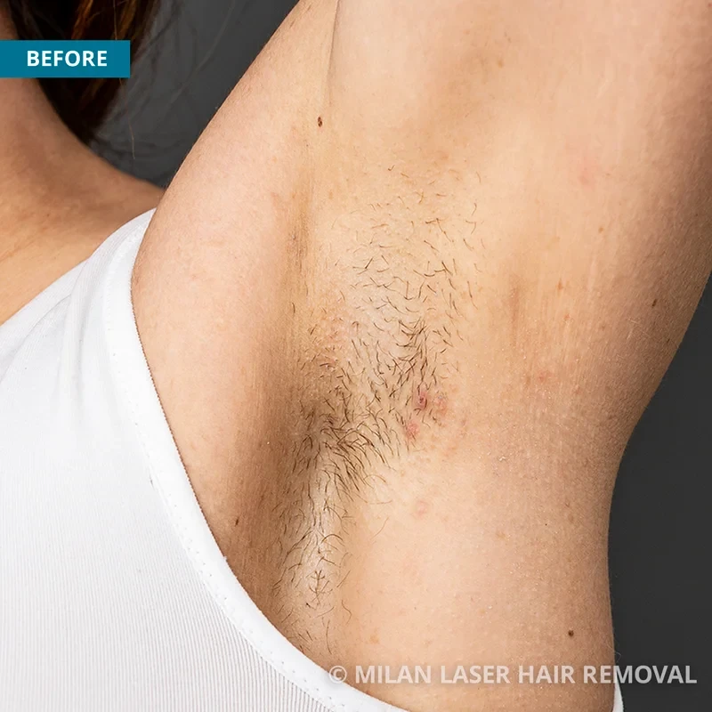 Before photo of a underarm prior to getting our underarm laser hair removal treatment