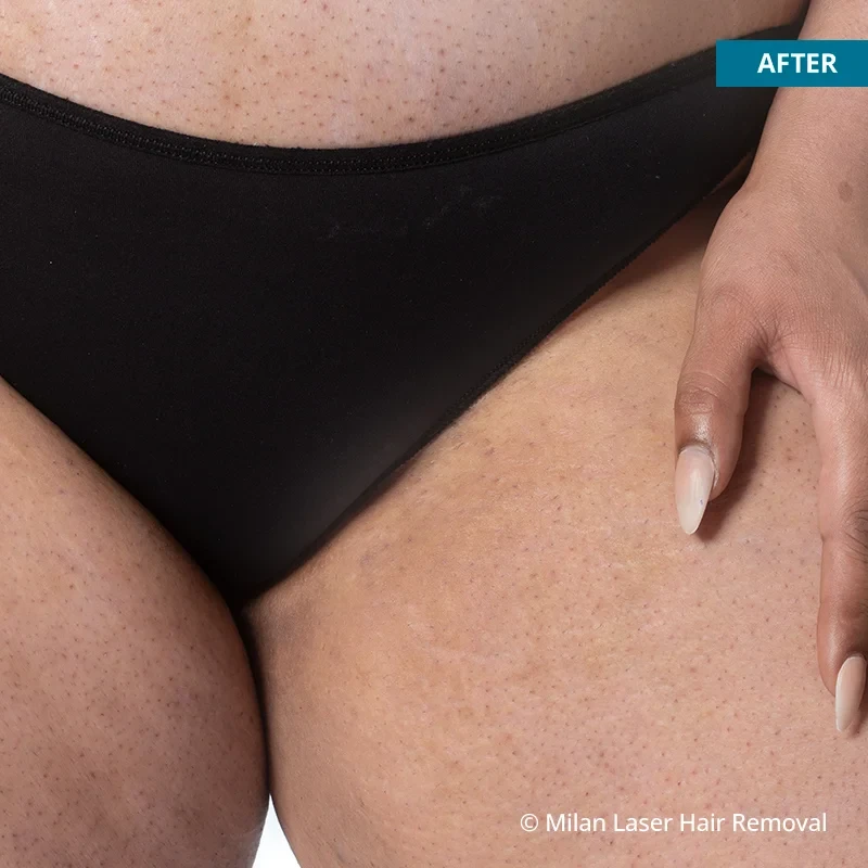 After photo of a bikini after getting our bikini laser hair removal treatment