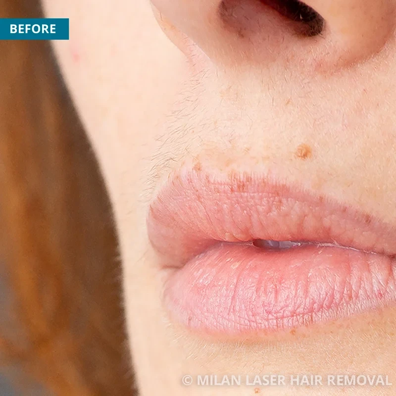 Before photo of a lip prior to getting our lip laser hair removal treatment